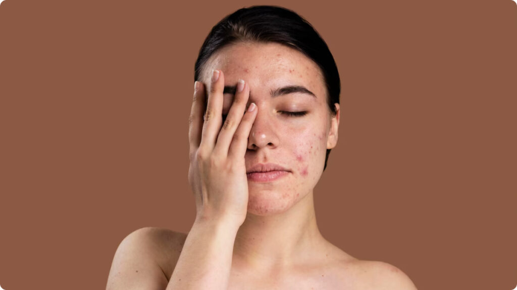 Espinhas Inflamadas
